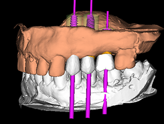 ABGuidedService Schritt 2: 3D-Behandlungsplanung