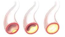 Atherosklerose – verengte Arterie