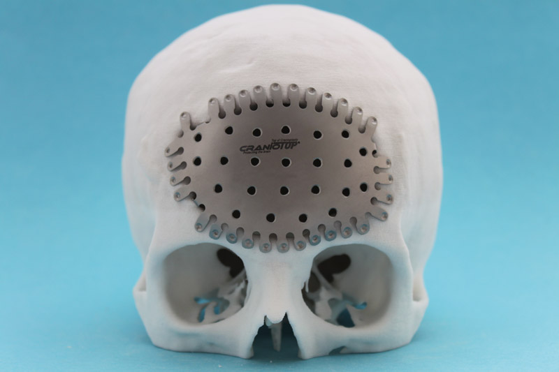 cranioTOP-Implantat