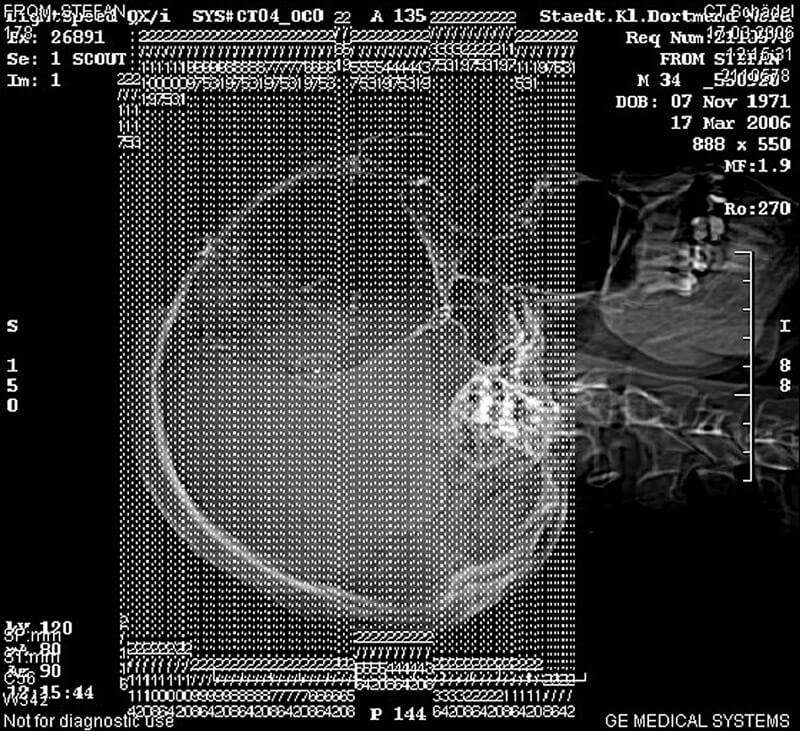 MRT-Kompatibilität cranioTOP