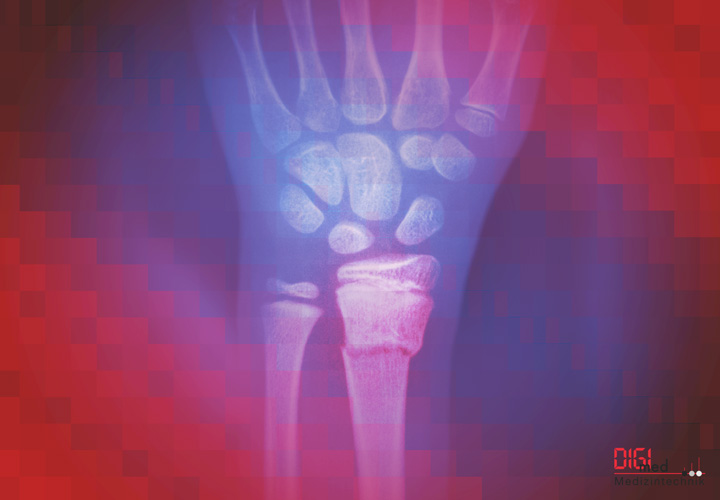 Unterarm-Implantate und Instrumente