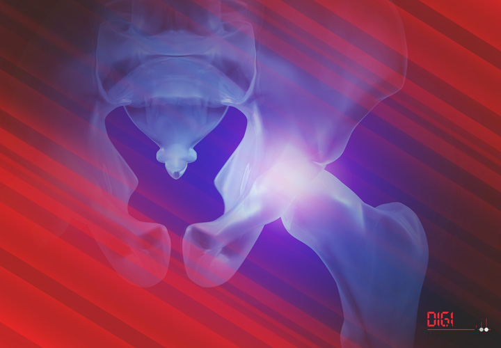 Becken-Instrumente und Titan-Implantate