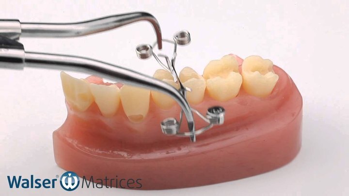 Walser dental matrix X-shape in Anwendung