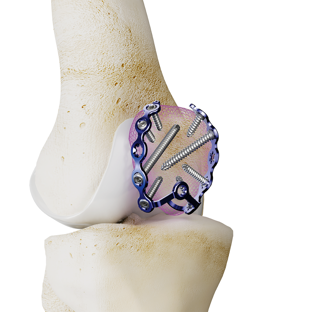 Patella-Platte 3.5