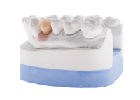 Zementierte Implantatkrone
