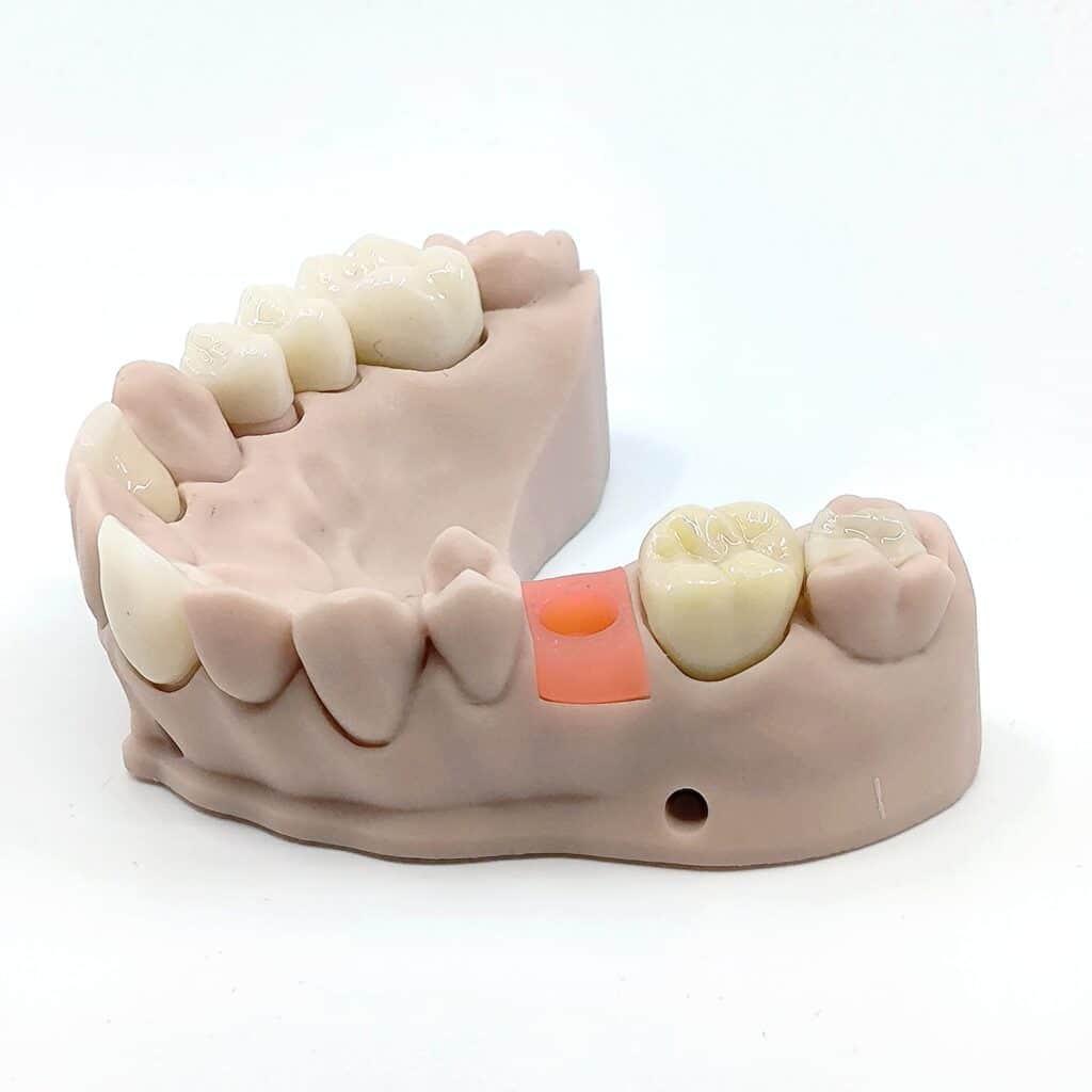 3D-gedruckte Zahnersatz-Komponenten