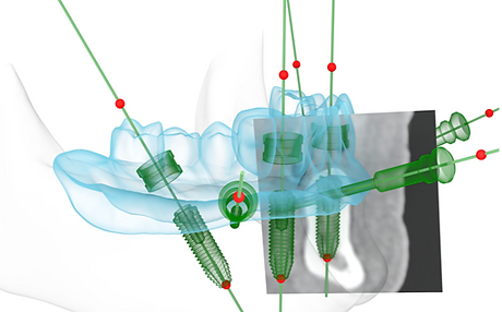 Implantatplanung / navigierte Implantologie