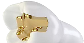 Inlay / Füllung aus CAD/CAM-Keramik